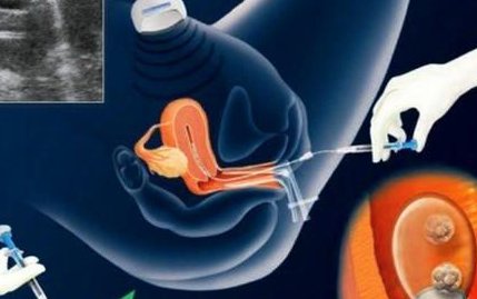 在上海治疗女性不孕不育价格是多少